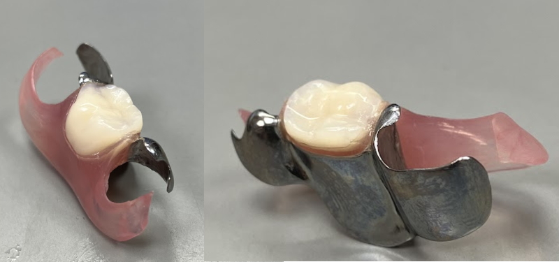 その他の義歯の写真(1歯欠損に対して作製されたコンティース)。審美性、咀嚼力に問題なし。